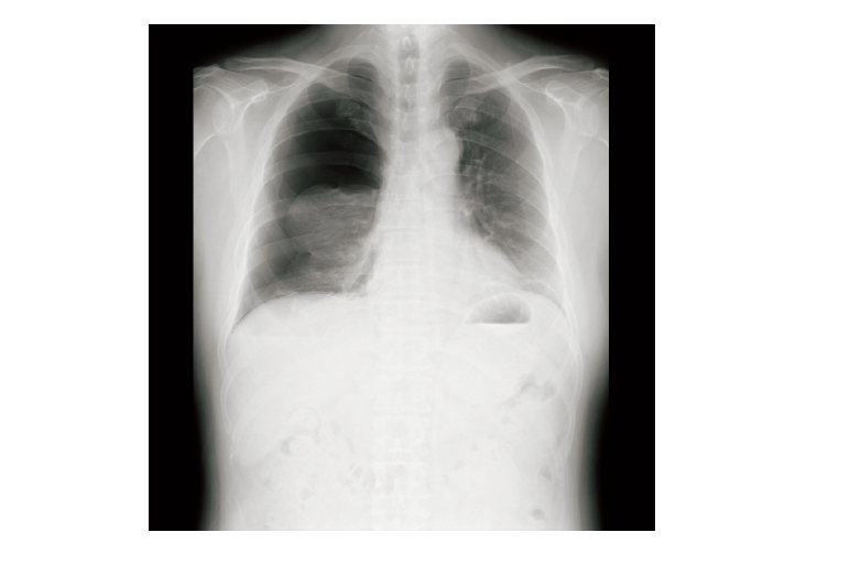 Aさん（24 歳、男性）は、突然出現した胸痛と呼吸困難があり、外来を受診した。意識は清明。身長 180 cm、体重 51 kg、胸郭は扁平である。20 歳から 40 本/日の喫煙をしている。バイタルサインは、体温 36.2 度、呼吸数 20/分（浅い）、脈拍 84/分、血圧 122/64 mmHg である。

胸部エックス線写真を示す。
Aさんの所見から考えられるのはどれか。